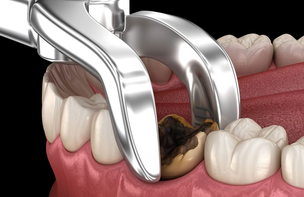 Preparing For A Tooth Extraction Procedure